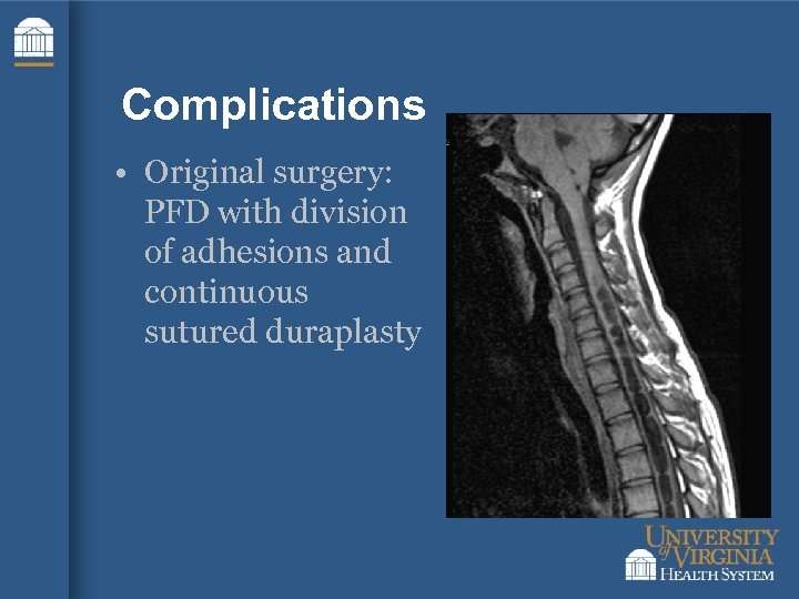 Complications • Original surgery: PFD with division of adhesions and continuous sutured duraplasty 