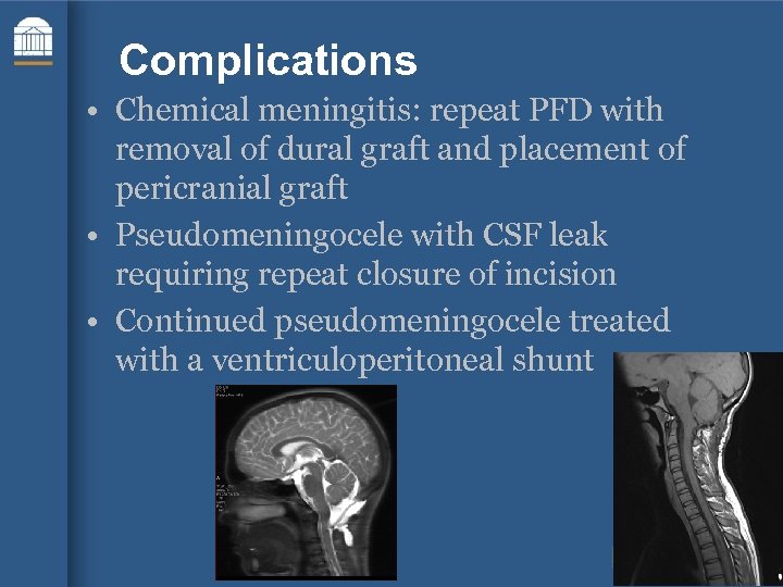 Complications • Chemical meningitis: repeat PFD with removal of dural graft and placement of