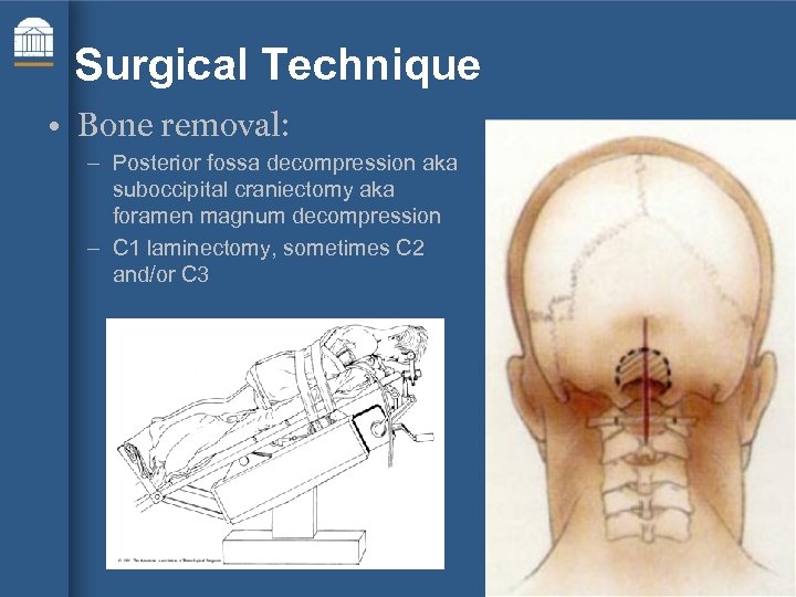 Surgical Technique • Bone removal: – Posterior fossa decompression aka suboccipital craniectomy aka foramen