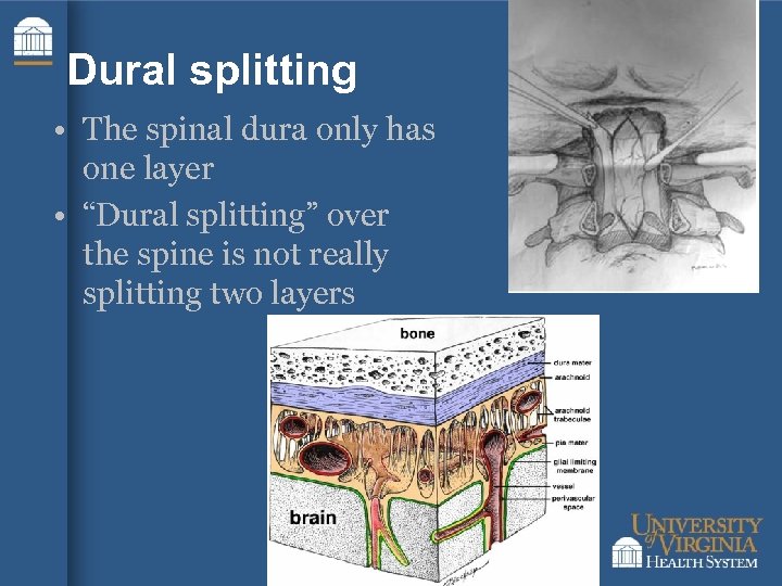 Dural splitting • The spinal dura only has one layer • “Dural splitting” over