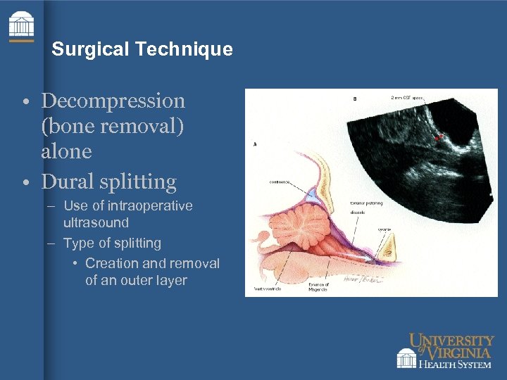 Surgical Technique • Decompression (bone removal) alone • Dural splitting – Use of intraoperative