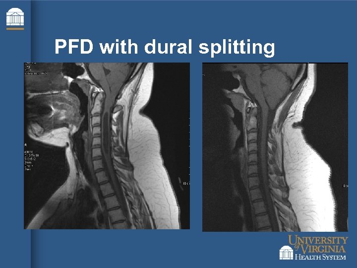 PFD with dural splitting 