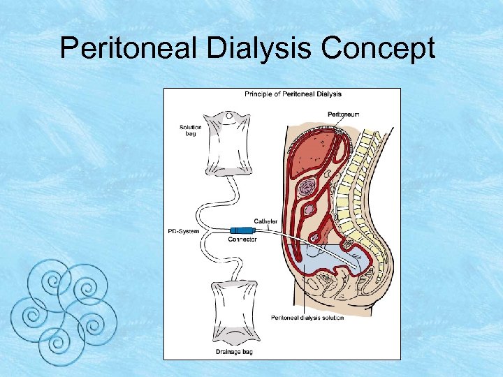 Peritoneal Dialysis Concept 