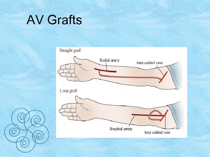 AV Grafts 