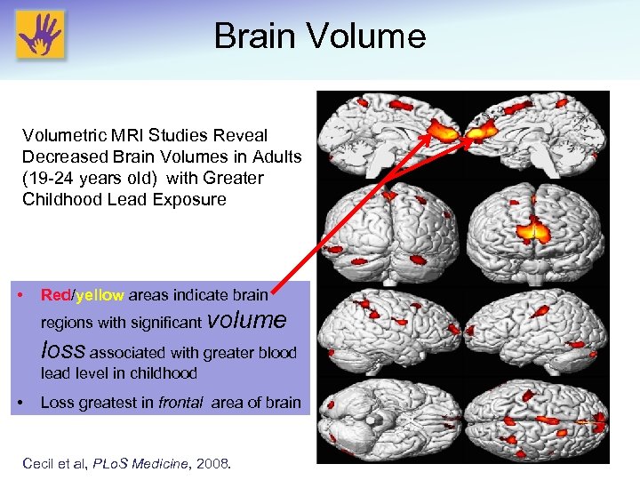 Brain Volumetric MRI Studies Reveal Decreased Brain Volumes in Adults (19 -24 years old)