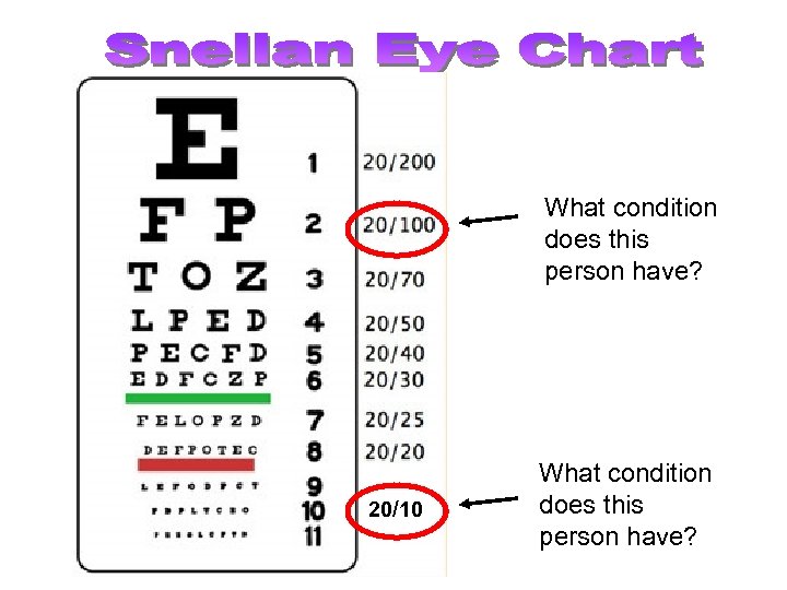 What condition does this person have? 20/10 What condition does this person have? 