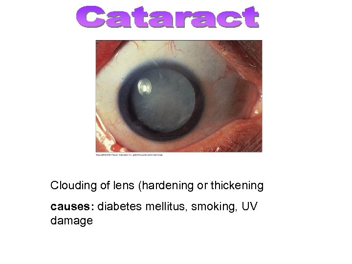 Clouding of lens (hardening or thickening causes: diabetes mellitus, smoking, UV damage 