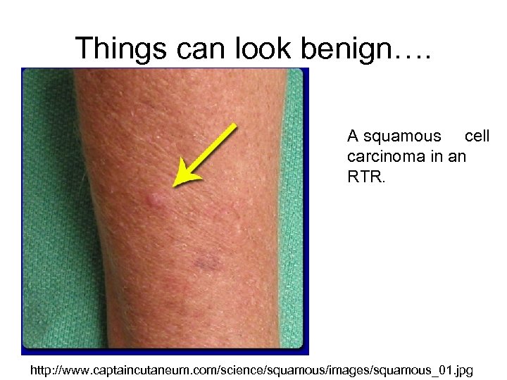 Things can look benign…. A squamous cell carcinoma in an RTR. http: //www. captaincutaneum.
