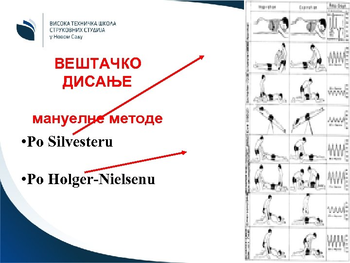 ВЕШТАЧКО ДИСАЊЕ мануелне методе • Po Silvesteru • Po Holger-Nielsenu 40 
