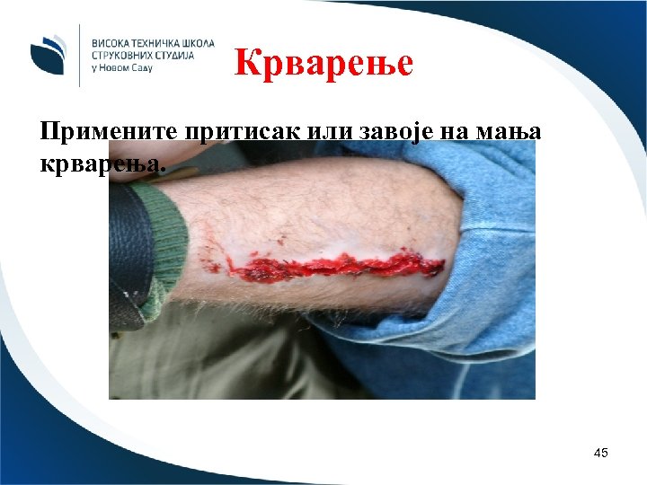 Крварење Примените притисак или завоје на мања крварења. 45 