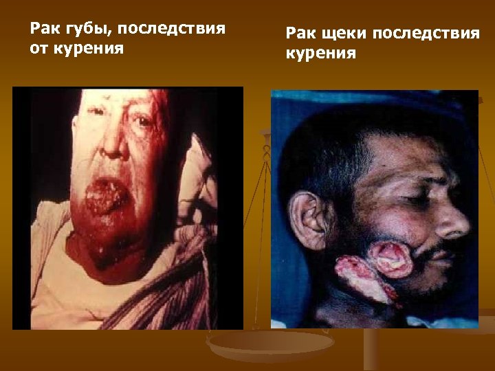 Рак губы, последствия от курения Рак щеки последствия курения 