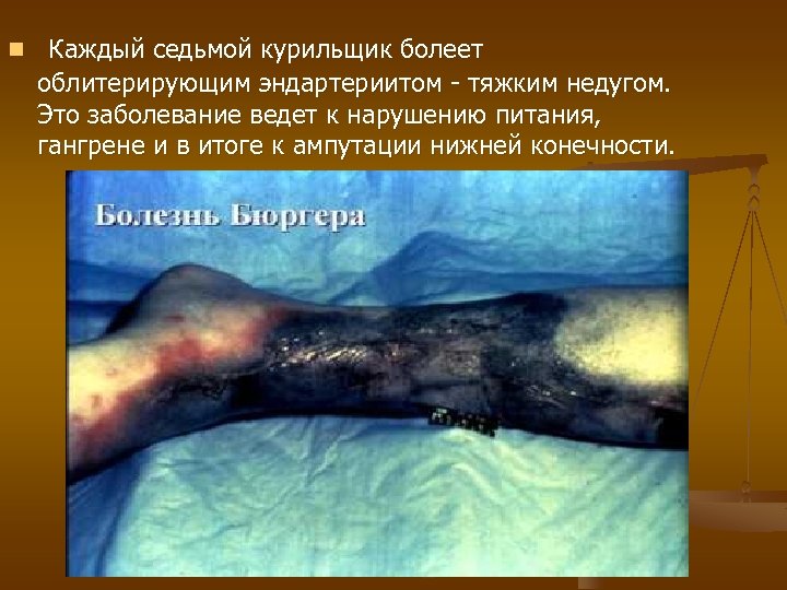 n Каждый седьмой курильщик болеет облитерирующим эндартериитом - тяжким недугом. Это заболевание ведет к