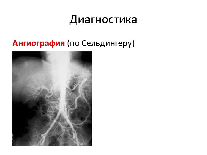 Схема по сельдингеру рентген