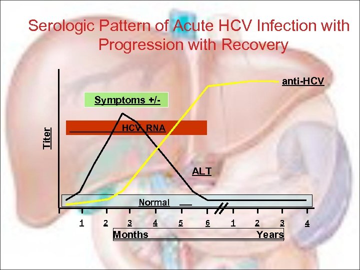 Serologic Pattern of Acute HCV Infection with Progression with Recovery anti-HCV Symptoms +/Titer HCV