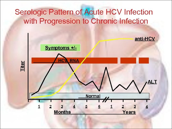 Serologic Pattern of Acute HCV Infection with Progression to Chronic Infection anti-HCV Symptoms +/Titer