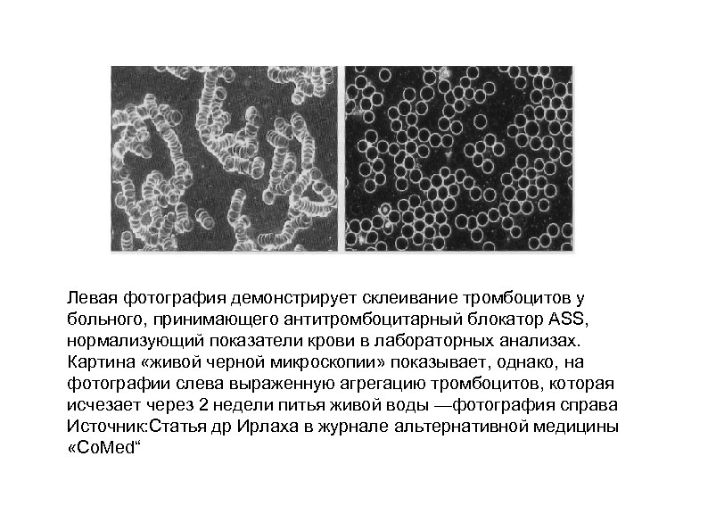 Левая фотография демонстрирует склеивание тромбоцитов у больного, принимающего антитромбоцитарный блокатор АSS, нормализующий показатели крови