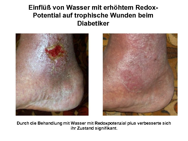 Einflüß von Wasser mit erhöhtem Redox. Potential auf trophische Wunden beim Diabetiker Durch die