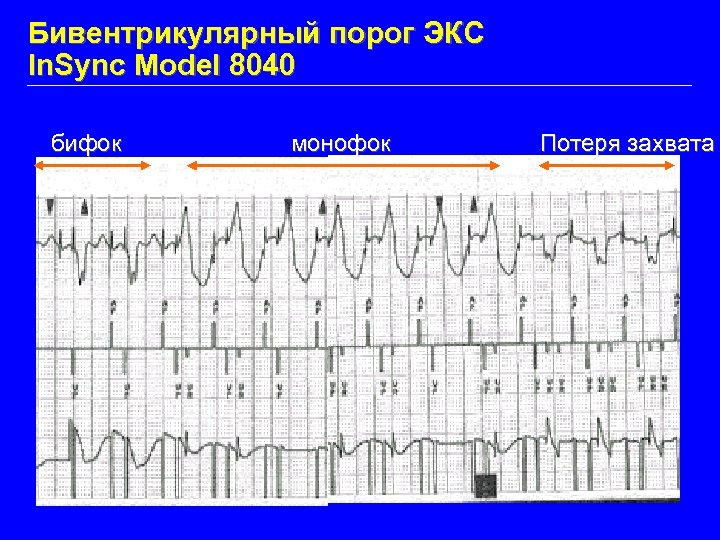 Бивентрикулярный порог ЭКС In. Sync Model 8040 бифок монофок Потеря захвата 