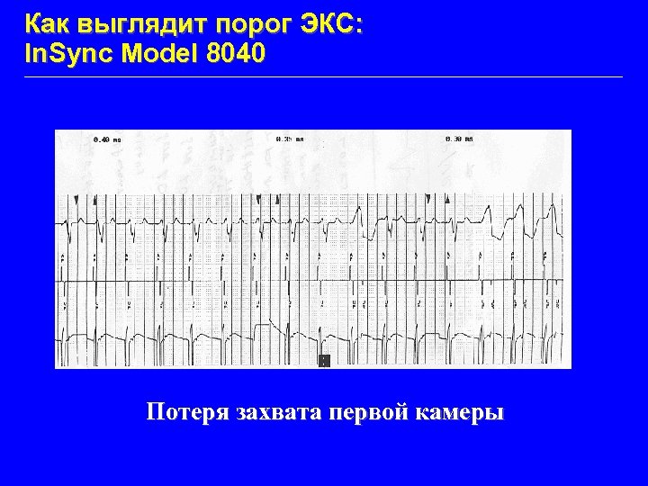 Как выглядит порог ЭКС: In. Sync Model 8040 Потеря захвата первой камеры 