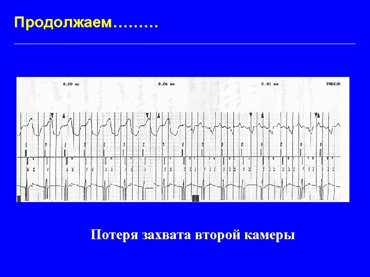 Продолжаем……… Потеря захвата второй камеры 