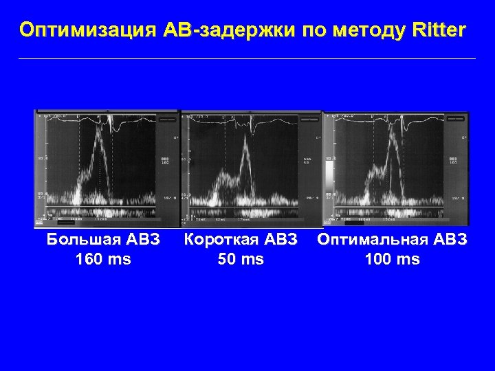 Оптимизация АВ-задержки по методу Ritter Большая АВЗ 160 ms Короткая АВЗ 50 ms Оптимальная