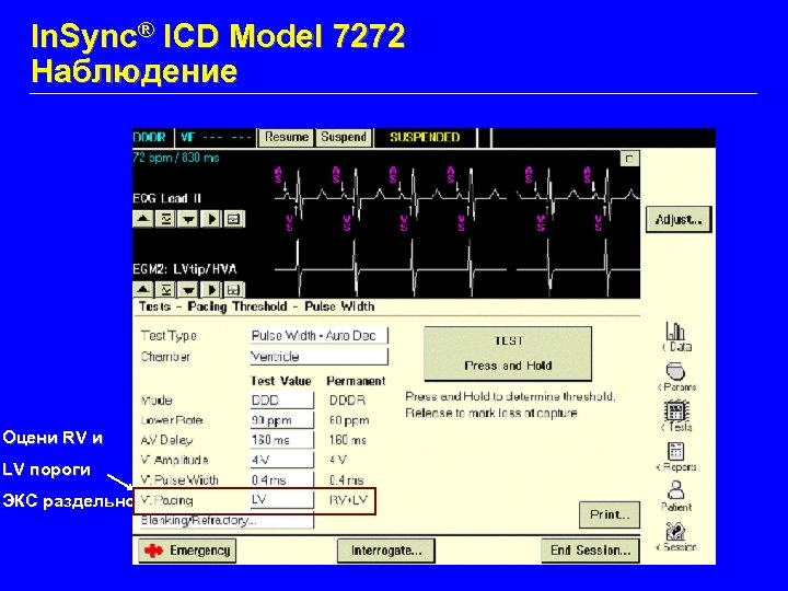 In. Sync® ICD Model 7272 Наблюдение Оцени RV и LV пороги ЭКС раздельно 