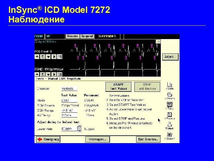 In. Sync® ICD Model 7272 Наблюдение 