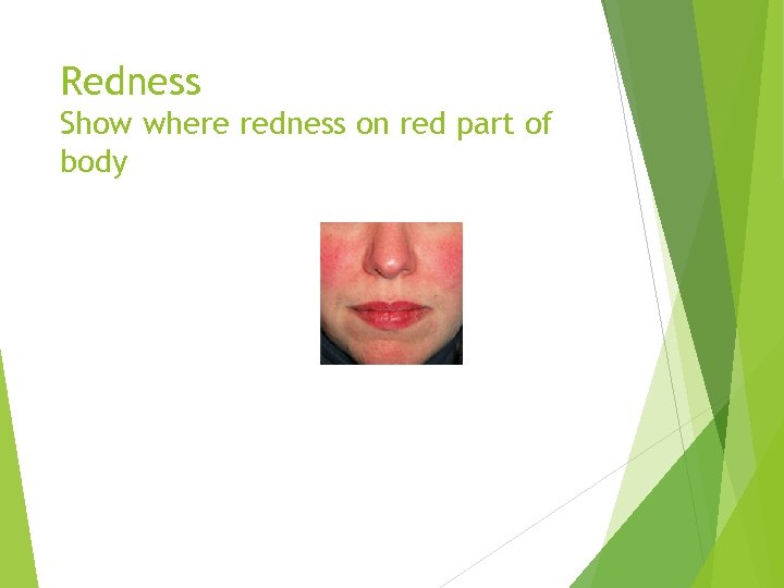 Redness Show where redness on red part of body 