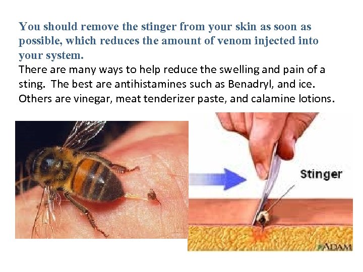 You should remove the stinger from your skin as soon as possible, which reduces