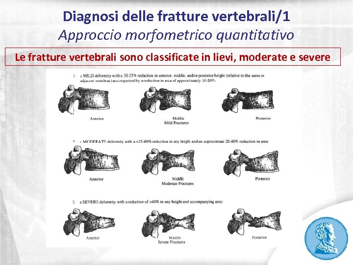 Diagnosi delle fratture vertebrali/1 Approccio morfometrico quantitativo Le fratture vertebrali sono classificate in lievi,
