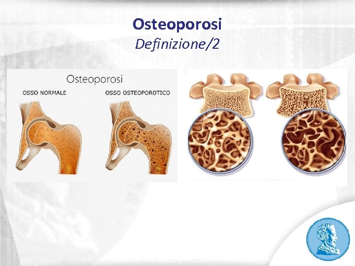 Osteoporosi Definizione/2 