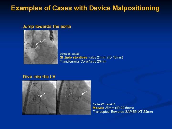 Examples of Cases with Device Malpositioning Jump towards the aorta Center #5, case#3 St