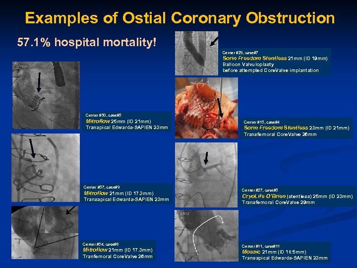 Examples of Ostial Coronary Obstruction 57. 1% hospital mortality! Center #29, case#7 Sorin Freedom