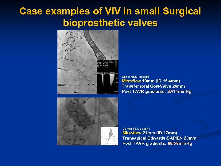 Case examples of VIV in small Surgical bioprosthetic valves Center #22, case#5 Mitroflow 19