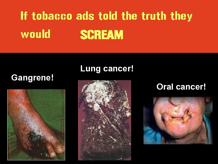 If tobacco ads told the truth they would SCREAM Gangrene! Lung cancer! Oral cancer!