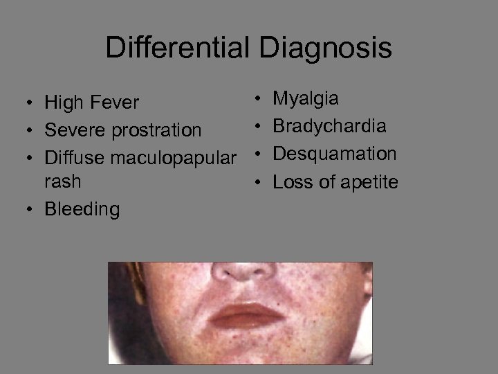 Differential Diagnosis • High Fever • Severe prostration • Diffuse maculopapular rash • Bleeding