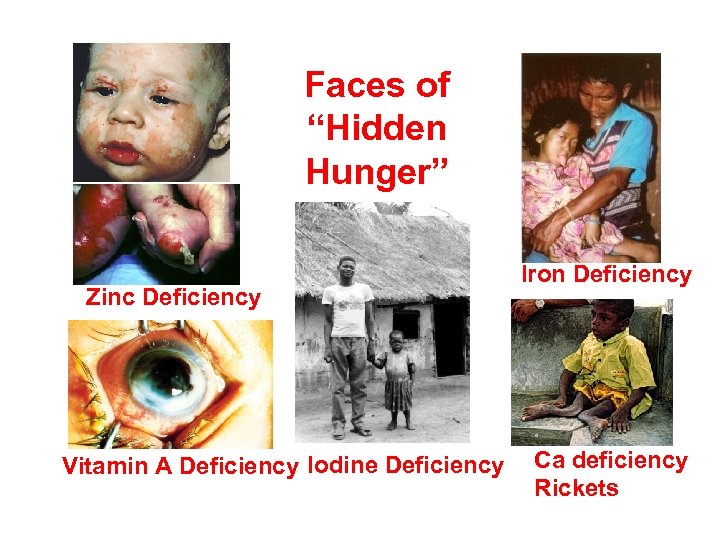 Faces of “Hidden Hunger” Zinc Deficiency Vitamin A Deficiency Iodine Deficiency Iron Deficiency Ca