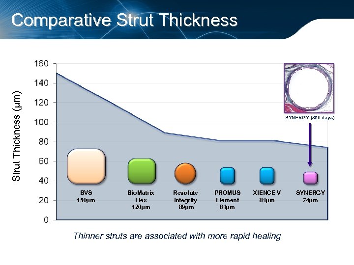 Strut Thickness (µm) Comparative Strut Thickness SYNERGY (360 days) BVS 150µm Bio. Matrix Flex