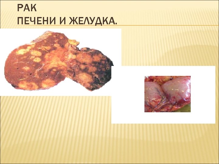 РАК ПЕЧЕНИ И ЖЕЛУДКА. 