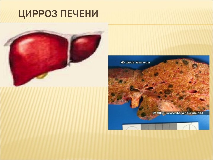ЦИРРОЗ ПЕЧЕНИ 