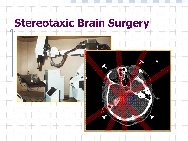 Stereotaxic Brain Surgery 
