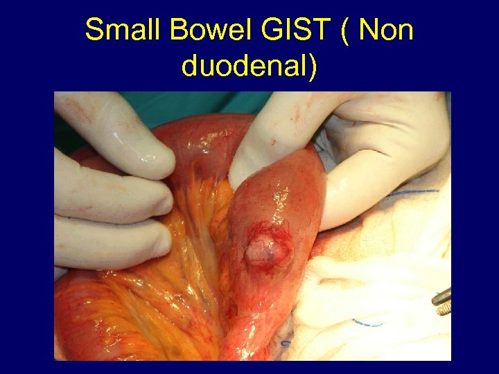 Small Bowel GIST ( Non duodenal) 