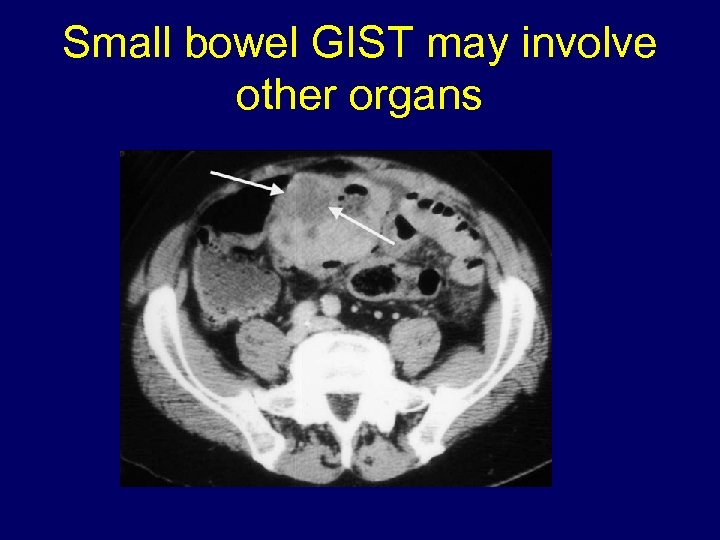 Small bowel GIST may involve other organs 