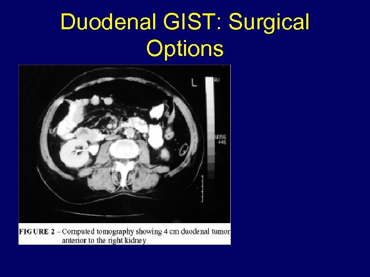 Duodenal GIST: Surgical Options 