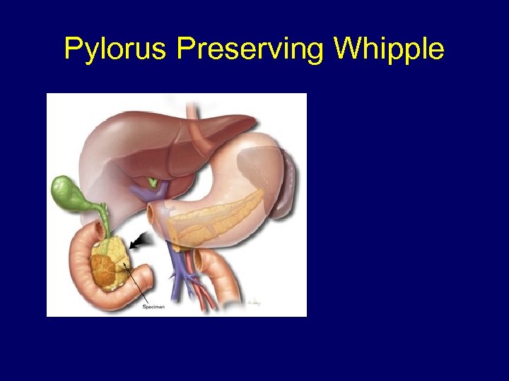 Pylorus Preserving Whipple 