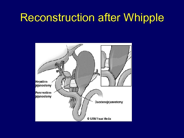 Reconstruction after Whipple 