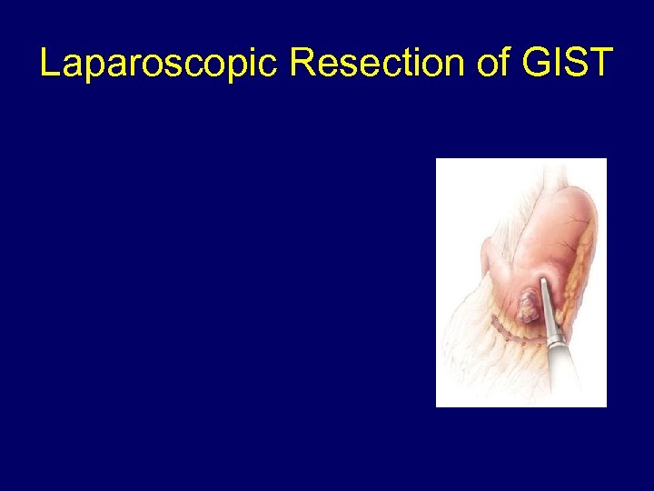 Laparoscopic Resection of GIST 