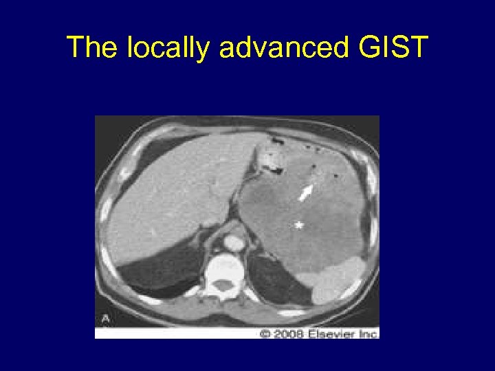 The locally advanced GIST 