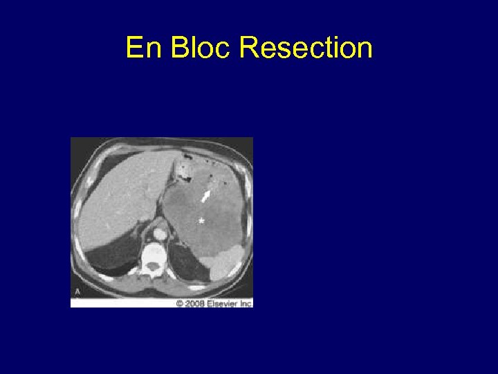 En Bloc Resection 