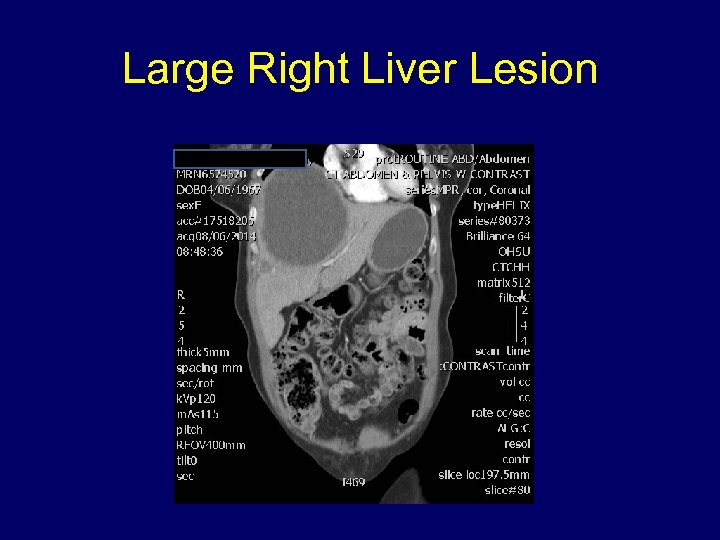 Large Right Liver Lesion 